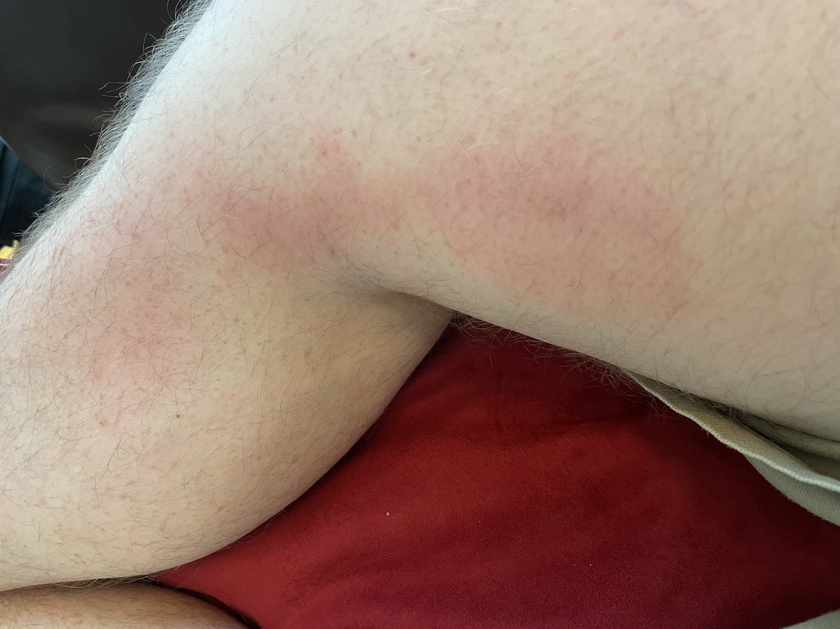 Blood_clot_leg